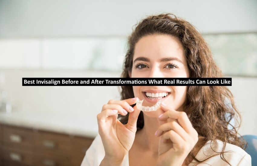 Best Invisalign Before and After Transformations What Real Results Can Look Like